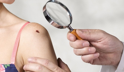 10 dấu vết bất thường trên cơ thể chỉ điểm ung thư